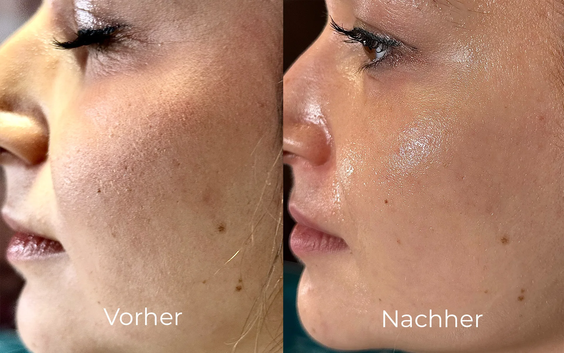 Before-and-after comparison demonstrating improved skin texture and radiance on the cheek area.